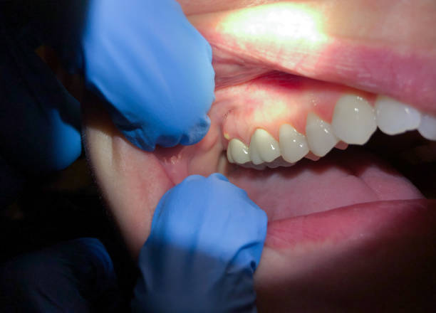 Best Broken or Chipped Tooth Repair in Pine Ridge, SC